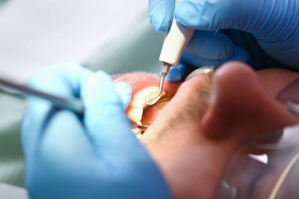 Best Emergency Wisdom Tooth Extraction in Demopolis, AL
